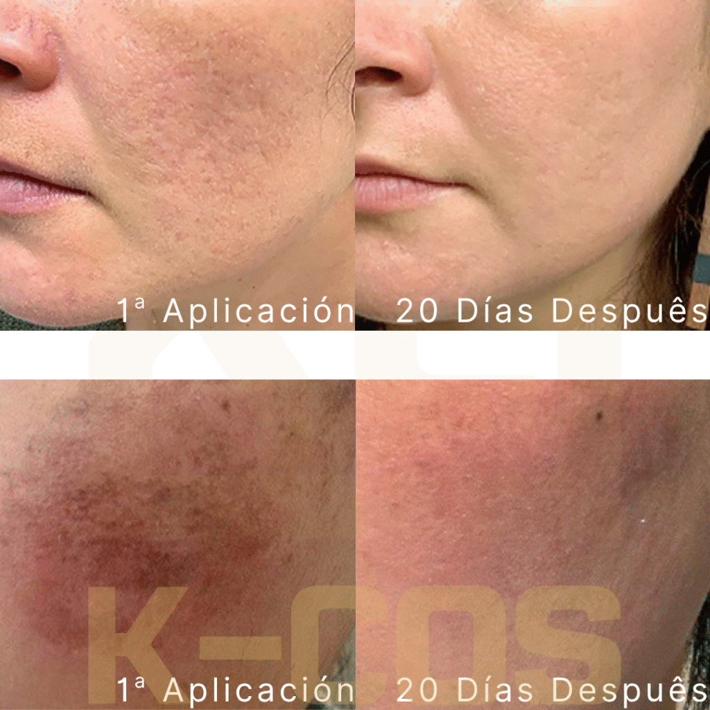 EXOSOMA hh exosome befaft kc