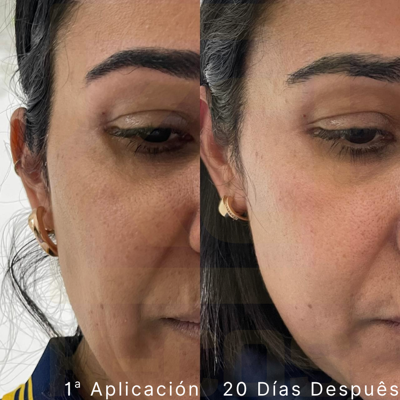 plla clinical data kc