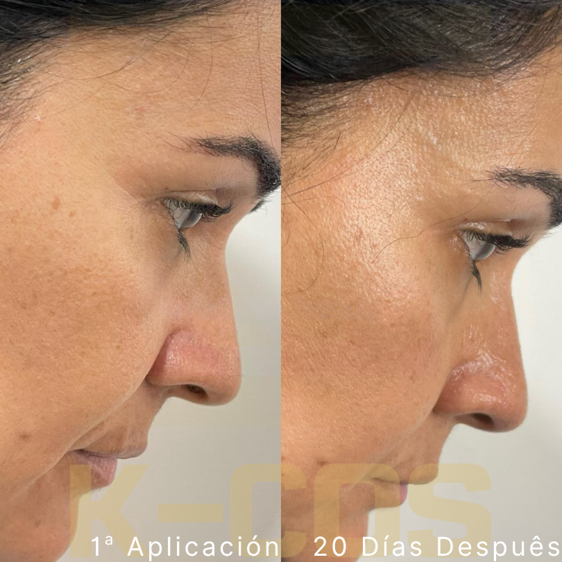 plla clinical data kc2